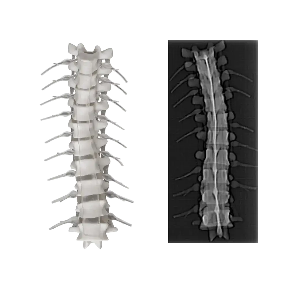 RadioMatrix 3D printed spine model with CT scan comparison